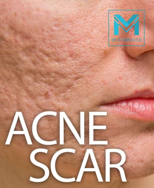 MI Acne Scar Treatment