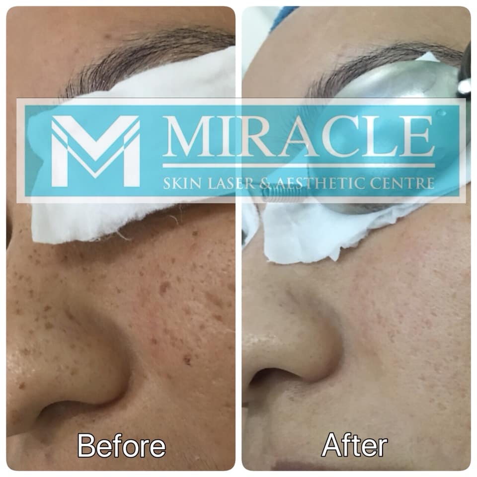 Miracle Laser Centre Pigmentation Treatment Before After Jan 2020
