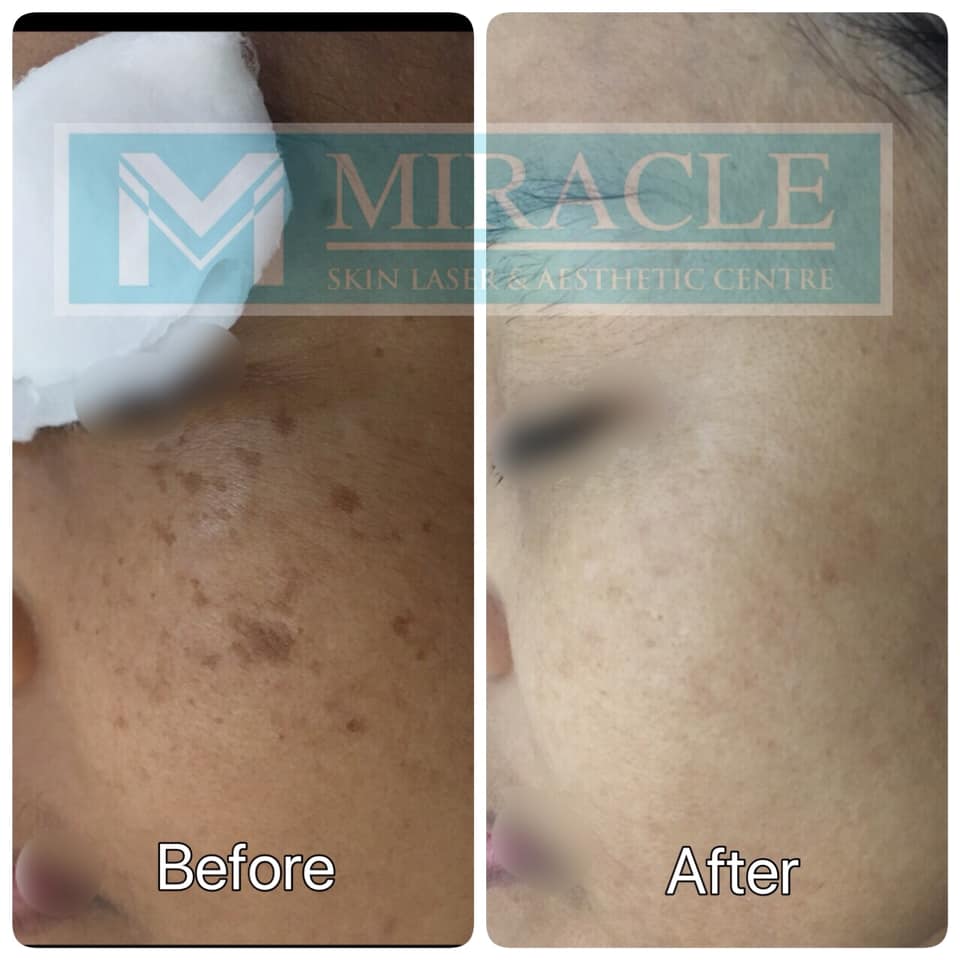 Miracle Laser Centre Pigmentation Treatment Before After May 2019