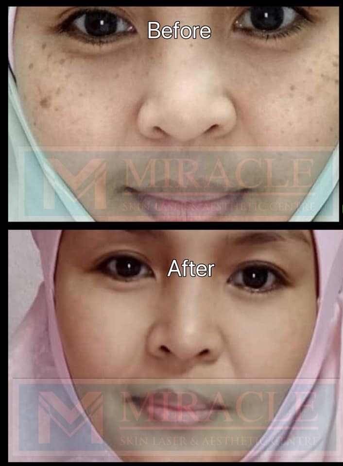 Miracle Laser Centre Skin Pigmentation Treatment Before After 2019