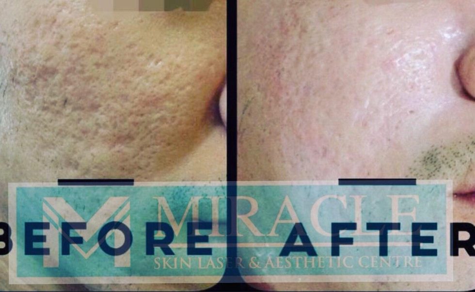 Pore Reduction Miracle Skin Laser & Aesthetic Centre