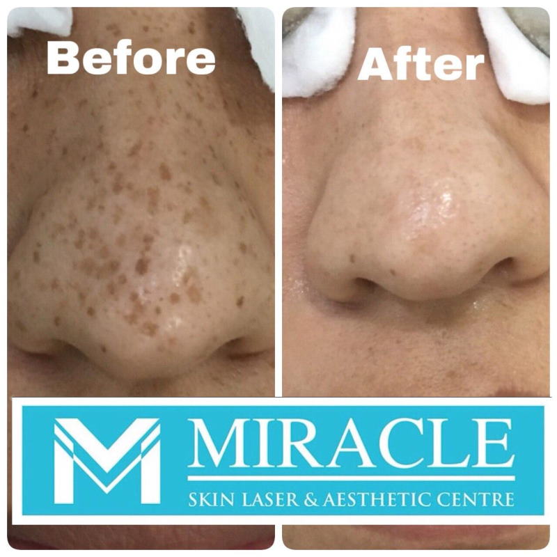 Miracle Laser Centre Pigmentation due to Hormonal Changes