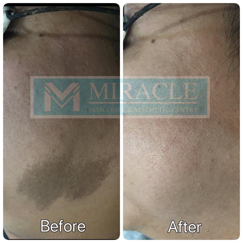 Miracle Laser Centre Skin Pigmention Removal