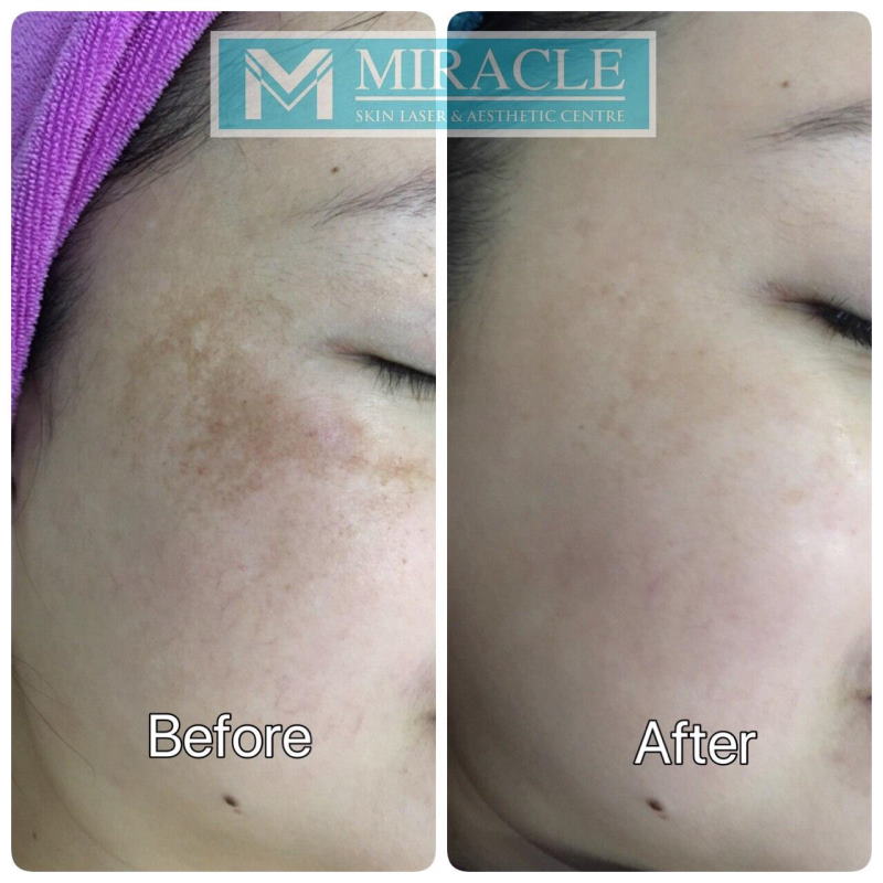 Miracle Laser Centre Pigmentation due to Hormonal Changes Female